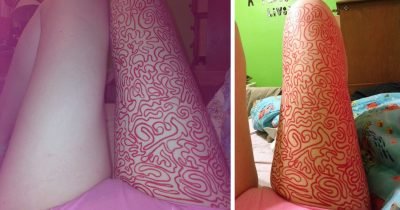 Girl Posts Therapist’s Advice To Draw On Her Body Instead Of Cutting